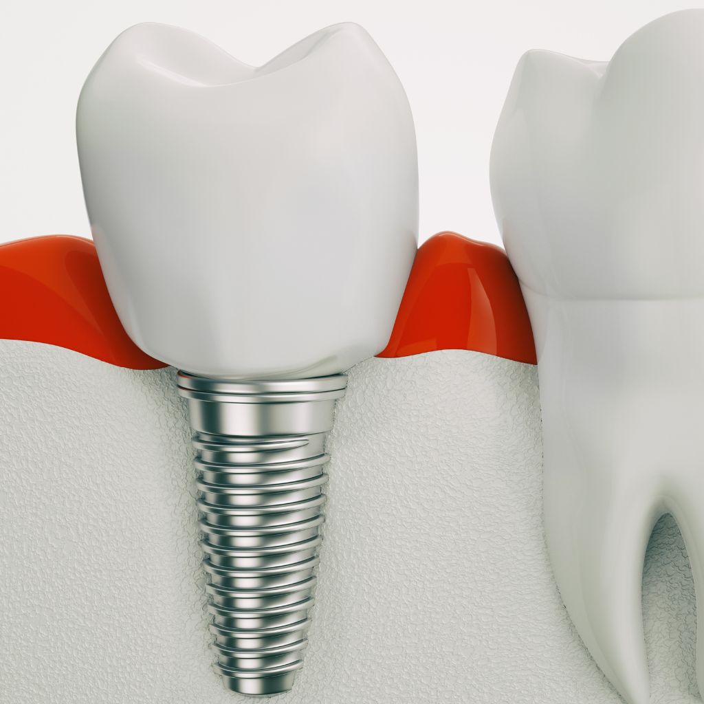 single dental implants