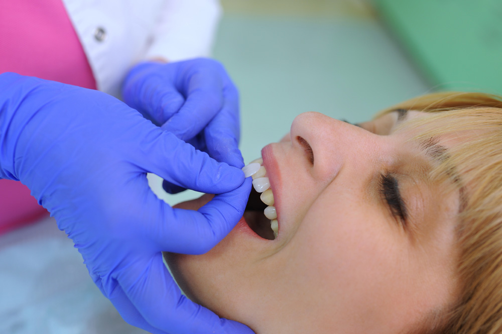 Dentist puts dental veneers on a patient's teeth