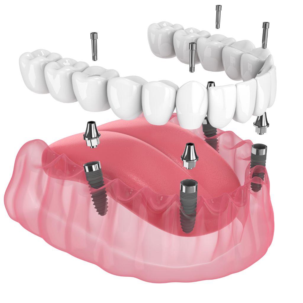 all o n4 dental implant