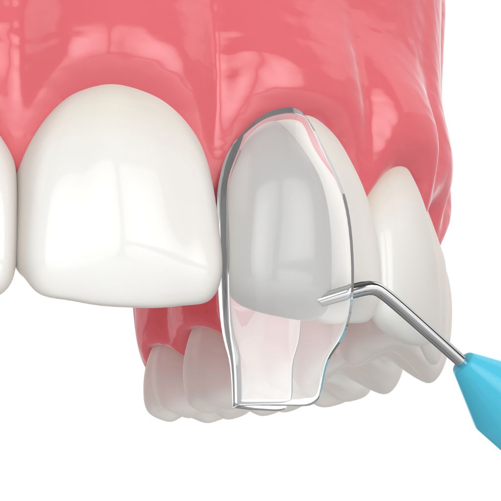 dental bonding illustration