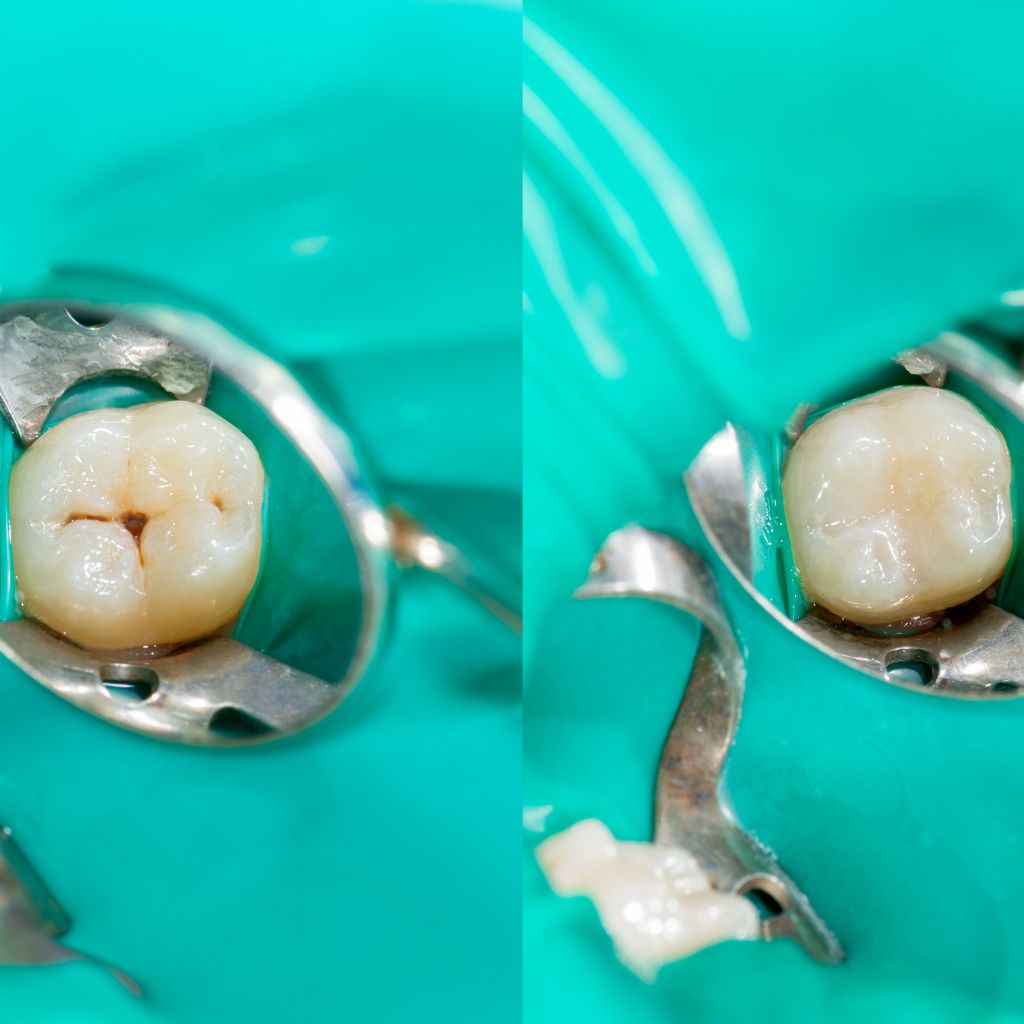 dental sealant