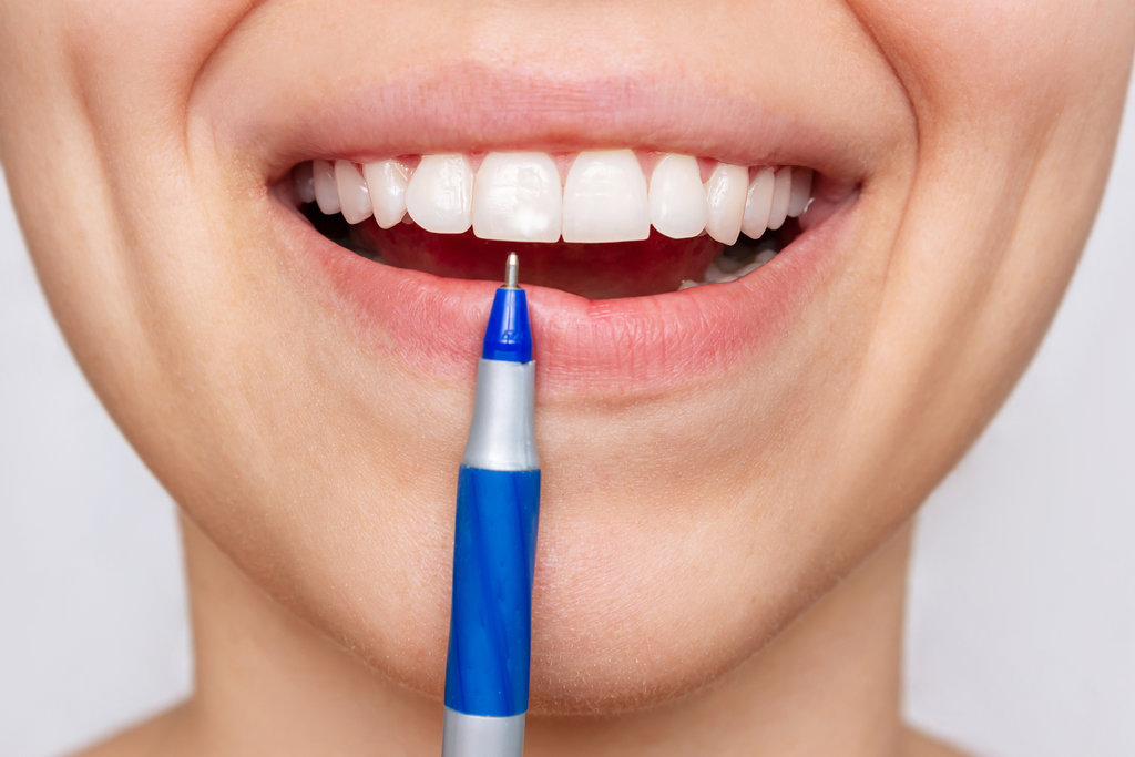 Cropped shot of a young woman pointing to white spot on the tooth enamel with a pen. Oral hygiene, dental health care. Dentistry, demineralization of teeth, enamel hypoplasia, pathology, fluorosis