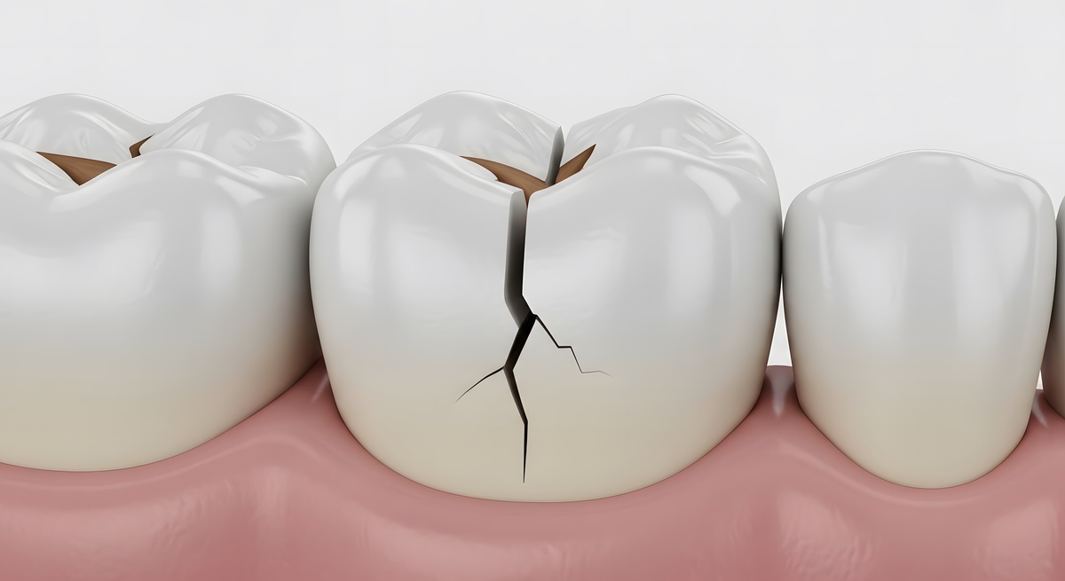Close up of a cracked tooth with visible damage and decay