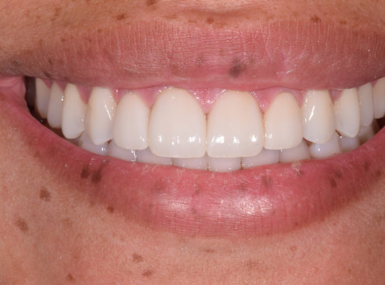 Close-up of a person's mouth showing clean, straight white teeth and natural moles around the lips.