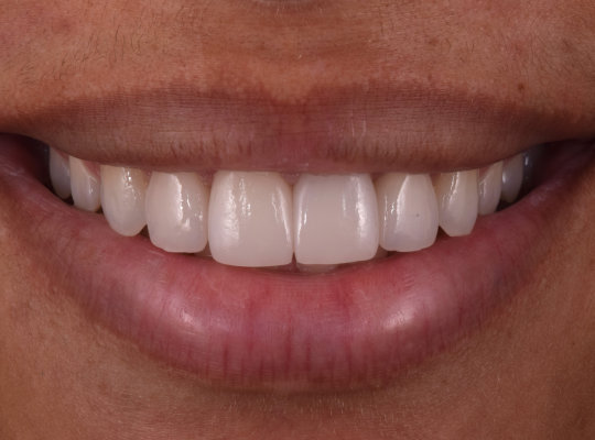 A close-up of a person's mouth smiling, showing clean, straight upper and lower teeth.