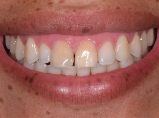 Close-up of a person's smile showing upper and lower teeth, with two front teeth visibly more yellow than the others.