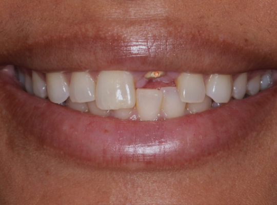 A close-up of a person's mouth showing teeth with a gap and a visible gold dental implant in the upper front gum.