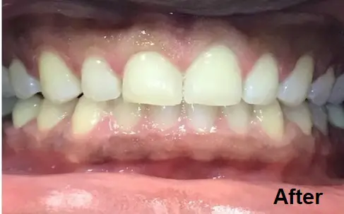 Close-up of a person's teeth after dental treatment, with teeth appearing aligned and gums healthy; "After" is labeled in the bottom right corner.