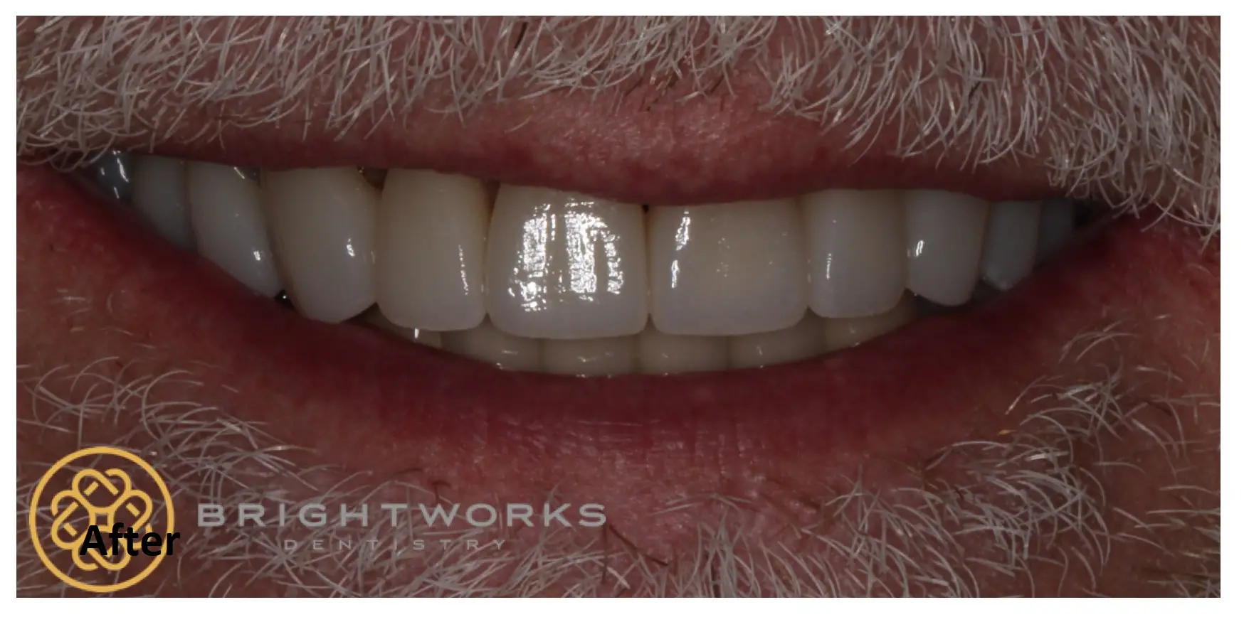 Close-up of a person's smile showing clean, straight teeth. "BRIGHTWORKS DENTISTRY" logo and the word "After" are visible in the lower left corner.