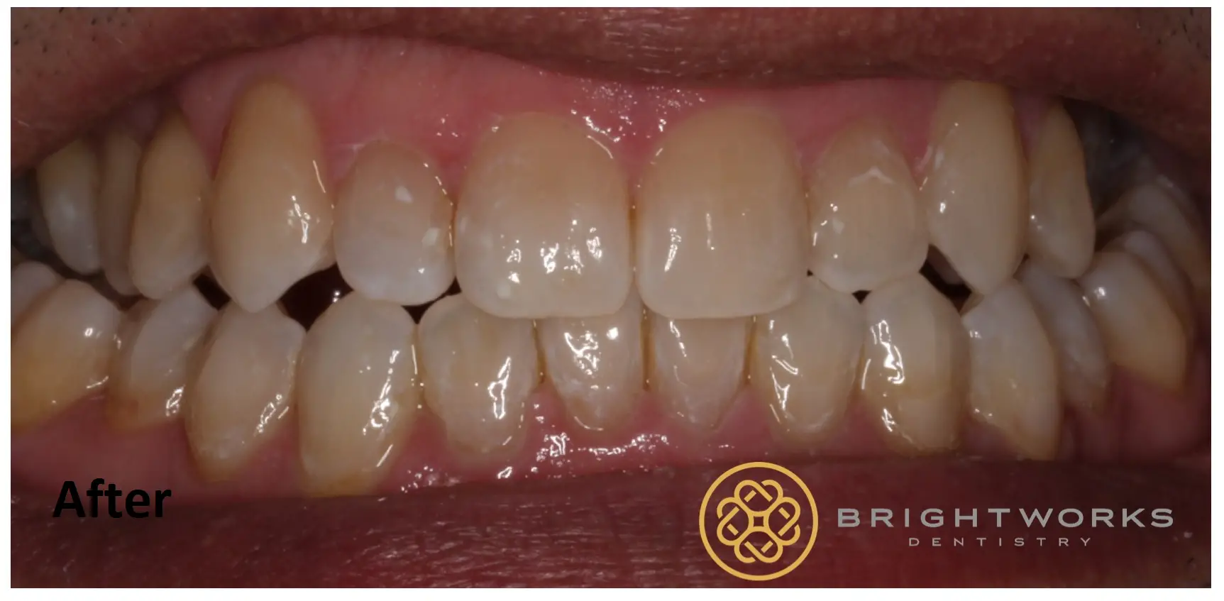 Close-up of a person's teeth after dental treatment, showing aligned and clean teeth with the Brightworks Dentistry logo at the bottom right.
