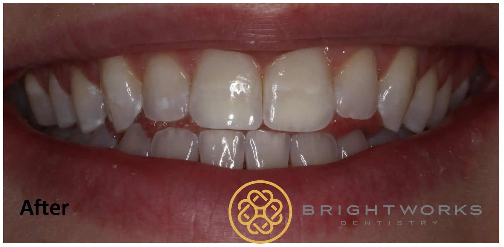 Close-up of a person's teeth after dental treatment, with the Brightworks Dentistry logo and the word "After" in the bottom left corner.