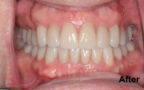 A close-up of a person's mouth showing a full set of straight, clean teeth after dental treatment. The word “After” is visible in the lower right corner.