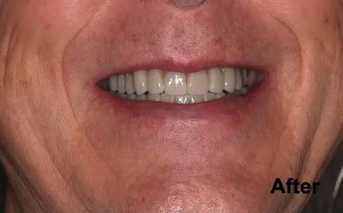 Close-up of a person's mouth showing straight, white teeth with the word "After" in the bottom right corner.