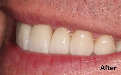 Close-up of a person's mouth showing clean, even, white teeth with the word "After" in the bottom right corner.