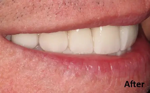 Close-up of a person's mouth showing even, white teeth after a dental procedure, with the word "After" in the lower right corner.