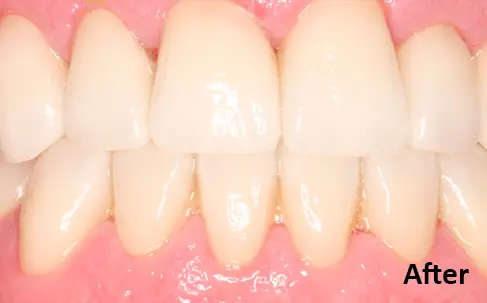 Close-up of clean, aligned upper and lower front teeth with healthy gums, labeled "After" in the lower right corner.