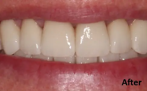 Close-up of a person's mouth showing straight, white teeth with the word "After" in the bottom right corner.