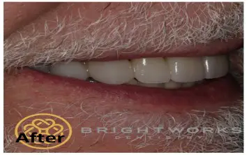 Close-up of an older man's mouth showing teeth after dental work, with white facial hair visible; "After" and "Bright Works Dental" logos are present.