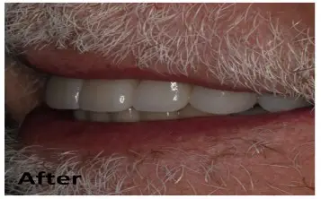 Close-up side view of an older man's mouth showing white, even teeth with dental crowns or veneers. The word "After" appears in the lower left corner.