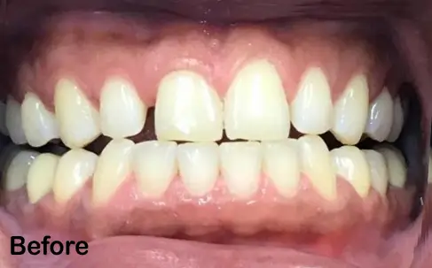 A close-up of a person's mouth showing their teeth before dental treatment, with visible misalignment and discoloration. The word "Before" is in the bottom left corner.