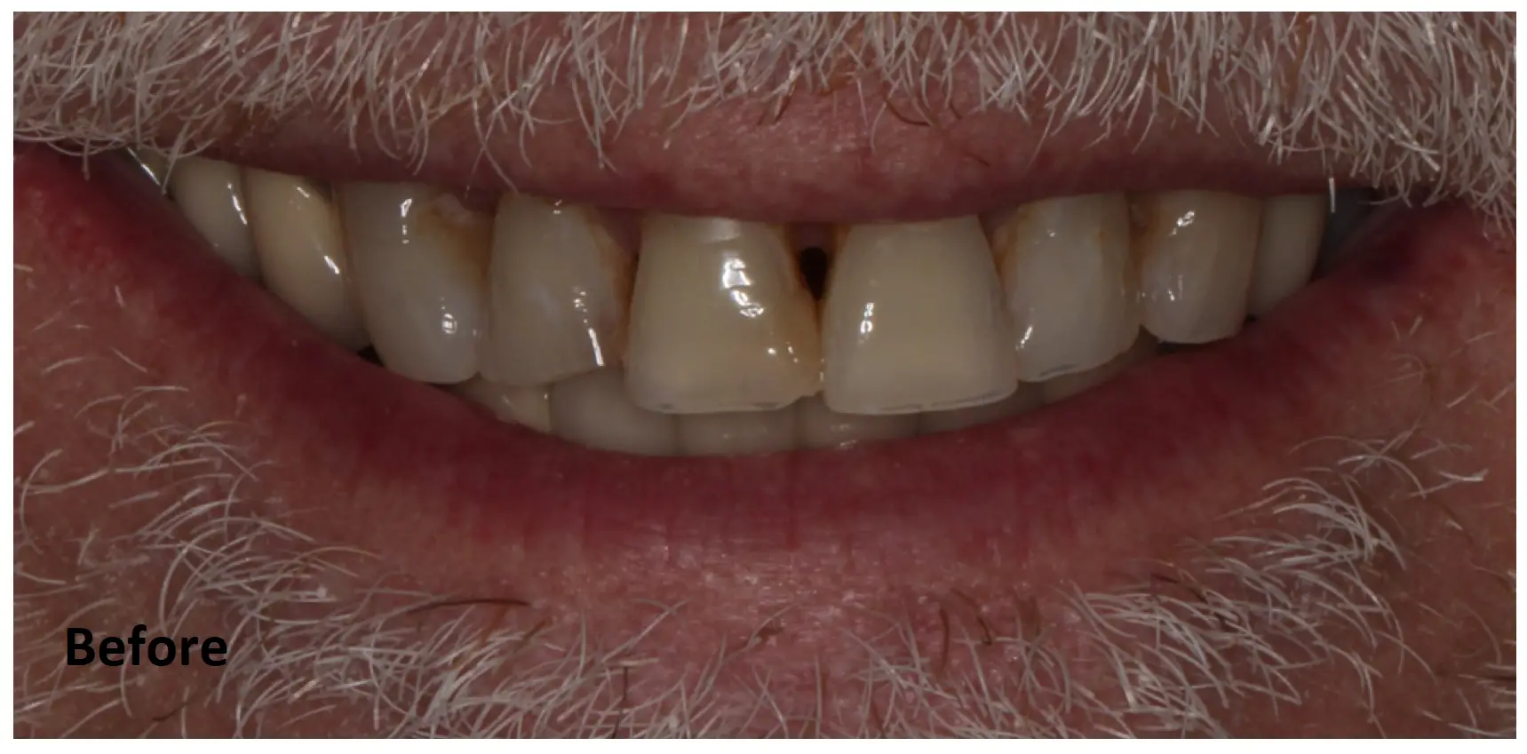 Close-up of an older person's mouth showing upper front teeth with visible gaps, discoloration, and surface staining; "Before" text appears in the lower left corner.