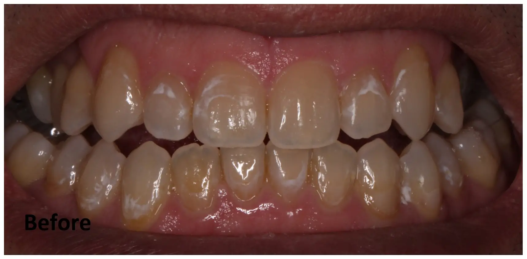 Close-up of a person's teeth before treatment, showing some yellow discoloration and plaque buildup on both upper and lower teeth. "Before" text is visible in the lower left corner.