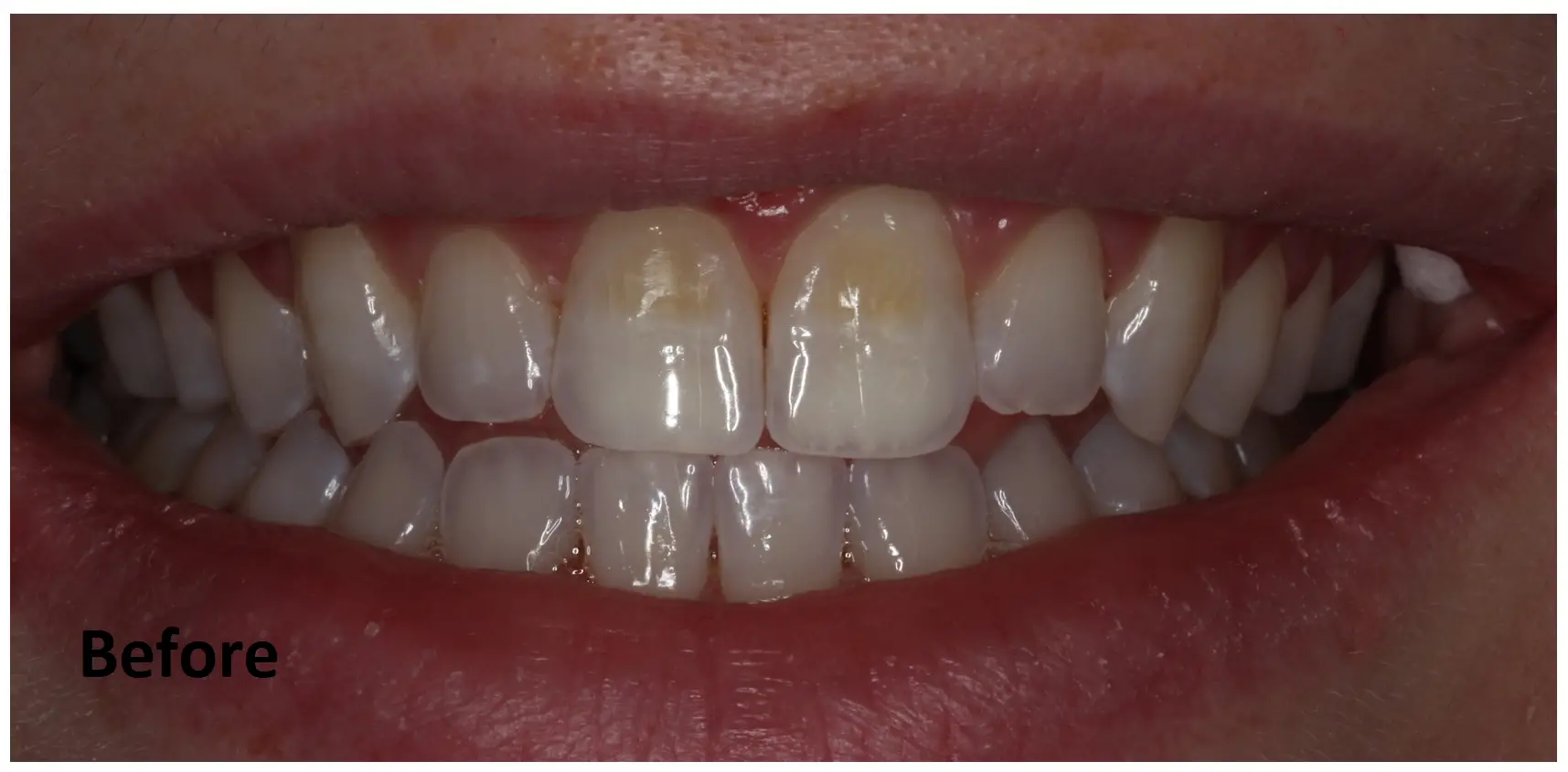 Close-up of a person's teeth showing some yellow discoloration on the two front upper teeth, with the word "Before" in the lower left corner.