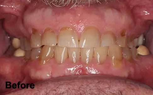 Close-up of a person's upper and lower teeth showing yellowing, plaque buildup, and uneven surfaces. The word "Before" appears in the lower left corner.
