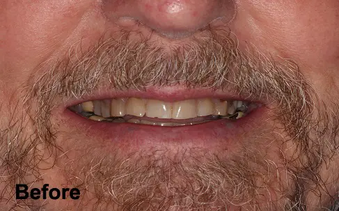 Close-up of an older man's mouth with discolored and uneven teeth, some dental crowns visible, and the word "Before" in the lower left corner.