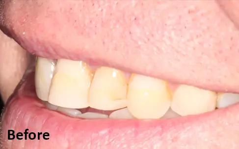 Close-up of a person's side smile showing yellowed teeth; the word "Before" is in the bottom left corner.