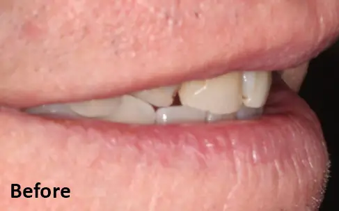 Close-up side view of a person's mouth showing slightly discolored and uneven upper teeth. The word "Before" appears in the lower left corner.