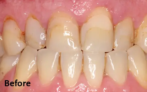 Close-up of upper and lower front teeth showing yellow staining near the gums and uneven tooth surfaces. The word "Before" appears in the lower left corner.