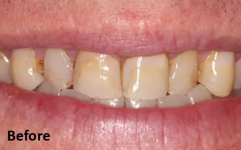 Close-up of a person's mouth showing stained and discolored teeth. The word "Before" appears in the lower left corner.