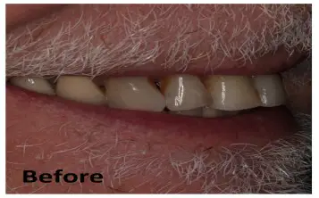 Close-up of a person's mouth showing yellowed, misaligned teeth and facial hair, with the word "Before" in the lower left corner.