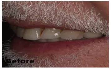 Close-up of an older person's mouth showing teeth with dental imperfections, labeled "Before" in the lower left corner.
