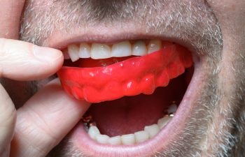 Man placing a red bite plate in his mouth to protect his teeth at night from grinding caused by bruxism close up view of his hand and the appliance