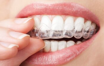 teeth with whitening tray